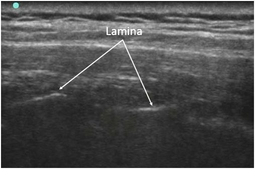 傍脊椎ブロック,retrolaminar block,paravertebral block,椎弓板