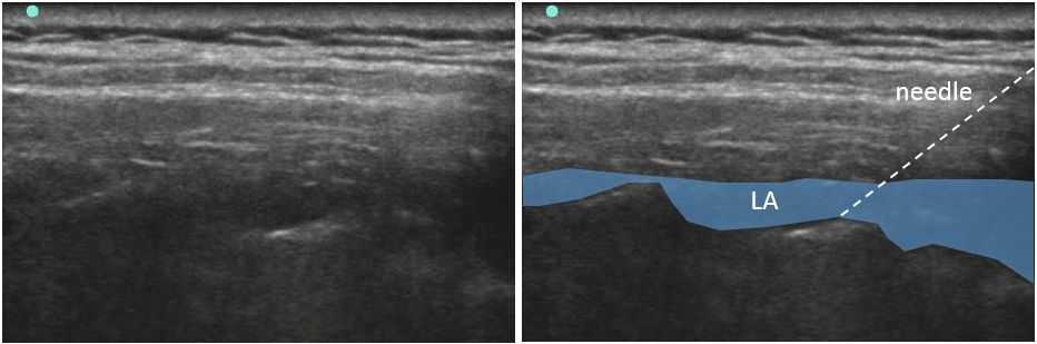 傍脊椎ブロック,retrolaminar block,paravertebral block,椎弓板