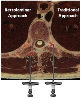 傍脊椎ブロック,retrolaminar block,paravertebral block,椎弓板