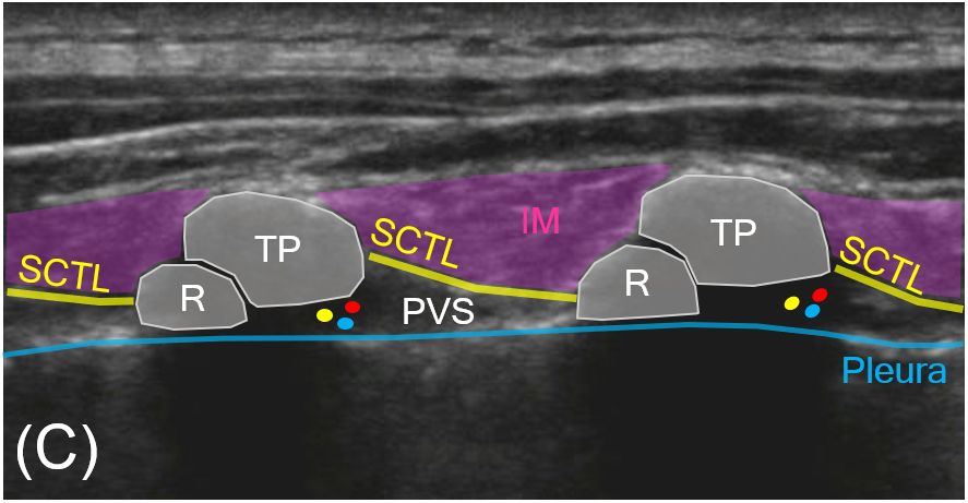 末梢神経ブロック,神経ブロック,エコーガイド,動画,画像
