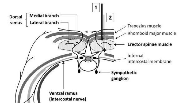 �����_�o�u���b�N,�_�o�u���b�N,�G�R�[�K�C�h,����,�摜,Erector Spinae Plane Block