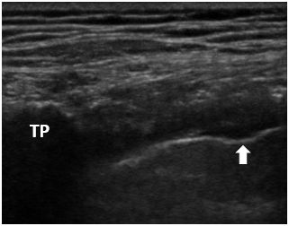 末梢神経ブロック,神経ブロック,エコーガイド,動画,画像